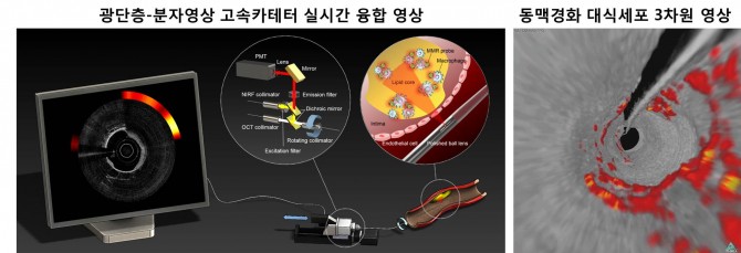 심장혈관 내로 들어가는 단일 미세 도관을 통해 혈관 내 구조와 염증활성도를 동시에 알 수 있다. 왼쪽 모니터 속 영상은 실시간으로 보여지는 영상이며, 오른쪽은 3차원으로 구성한 것. 붉은색 부분이 고위험 동맥경화반으로 진행되는 부분이다. - 고려대 구로병원·기초지원연구원 제공